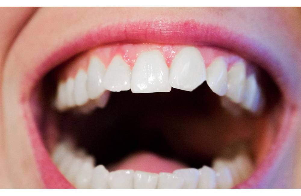 Ulomený či vyrazený zub na úsmeve a nálade nepridá