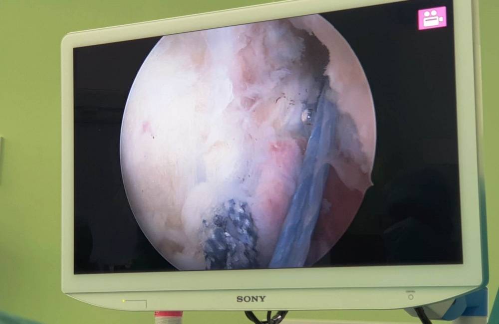 Foto: Novinka v nemocnici v Žiline: Nový typ operácie kolena skráti dobu liečby pacienta