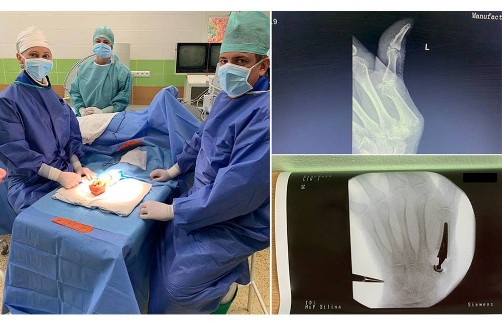 Žilinskí traumatológovia po prvýkrát úspešne implantovali umelú náhradu koreňového kĺbu palca