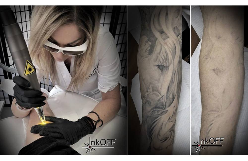 V Žiline otvorili profesionálne štúdio inkOFF zamerané na šetrné odstránenie nežiaduceho tetovania