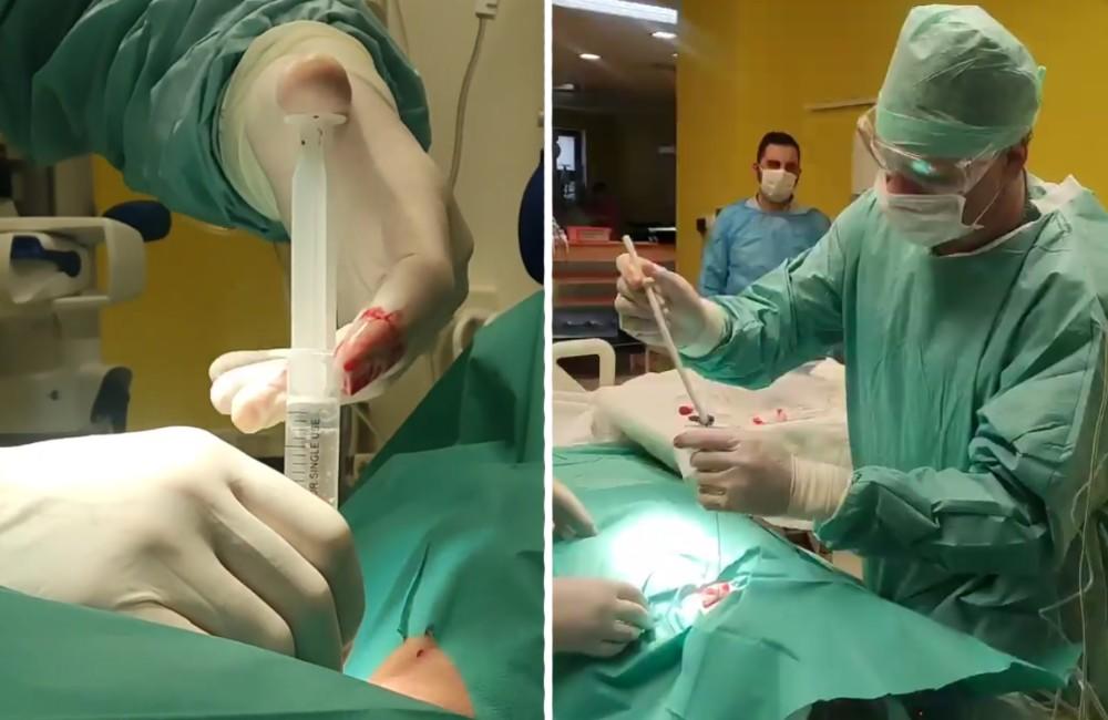 Foto: VIDEO: Žilinská nemocnica uverejnila zábery z operácie, ktorá pomáha pacientom dýchať