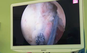 Novinka v nemocnici v Žiline: Nový typ operácie kolena skráti dobu liečby pacienta