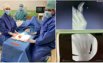 Žilinskí traumatológovia po prvýkrát úspešne implantovali umelú náhradu koreňového kĺbu palca