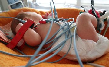 Krehké životy novorodencov v žilinskej nemocnici kontroluje nové EKG aj priamo v inkubátore