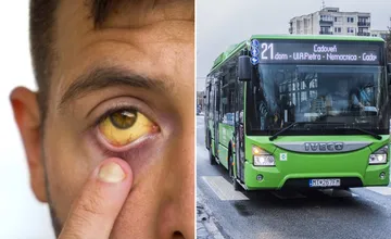 V Turci stále evidujú prípady žltačky, zomrela 59-ročná pacientka. MHD zavádza opatrenia