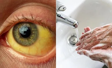 Žltačka sa šíri naďalej aj v Žilinskom kraji. Zdravotníci u nás evidujú 60 nových prípadov