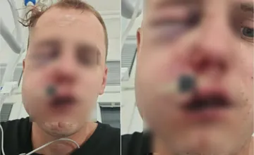 Brutálny útok v Námestove: Muža kopali do hlavy, dolámali mu kosti v tvári na padrť. Hľadá svedkov