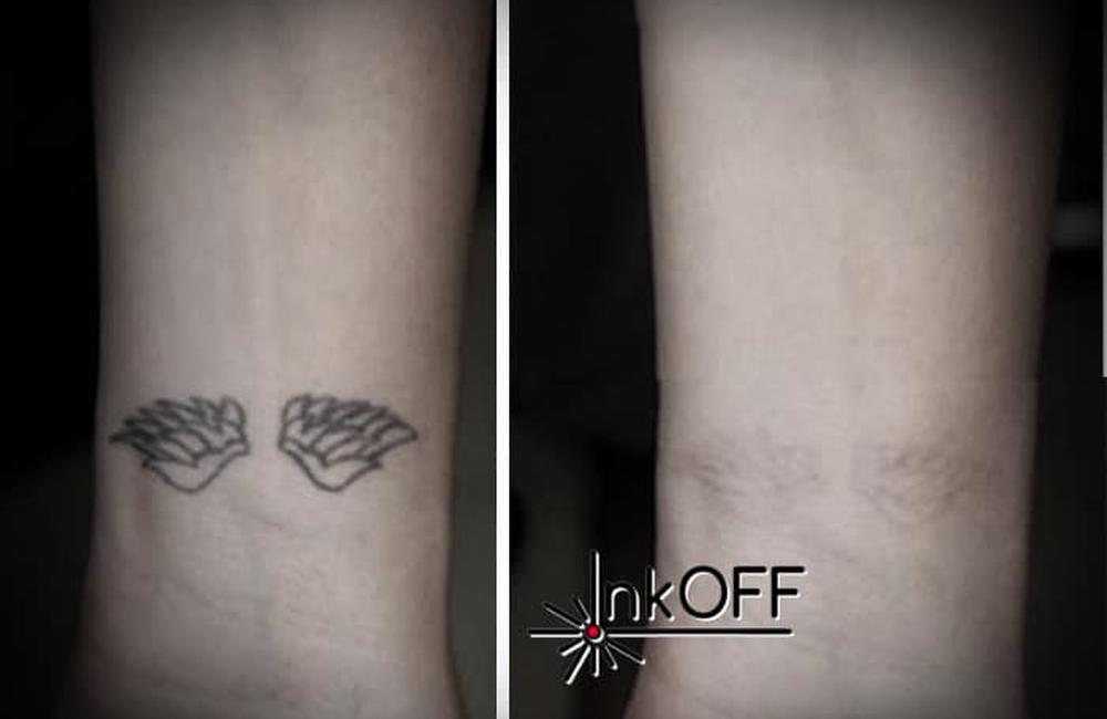 Odstránenie tetovania a zákroky Carbon Lifting inkOFF, foto 2
