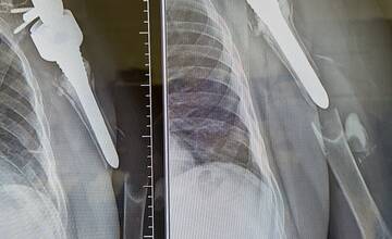 FOTO: Zriedkavá transplantácia kosti v Žiline